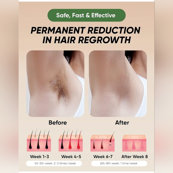 XSoul IPL Hair Removal System - Picture 5 of 8